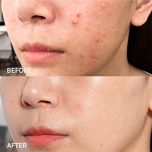 SOME BY MI AHA BHA PHA 14 Days Super Miracle Spot All Kill Cream - 1.01Oz, 30ml - Mild Korean Skin Trouble Spot Care Face Cream for Sensitive Skin - Skin Soothing and Calming Effect - Korean Skin Care